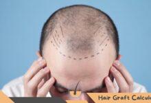 How to Choose the Right Hair Transplant Surgeon for Your Needs